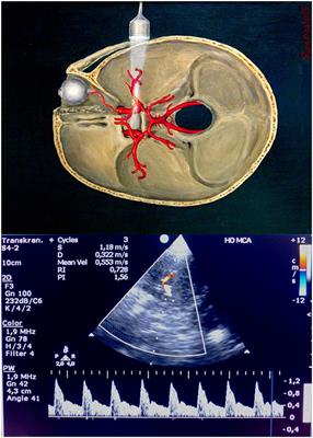 Transcranial Doppler during the first week after cardiac arrest and association with 6-month outcomes